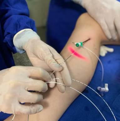 Certificate Course in Endovenous Laser Ablation and Sclerotherapy for Varicose vein